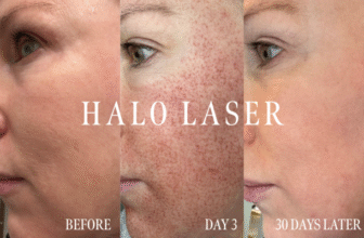 An Esthetician’s Halo Laser Review And Recovery