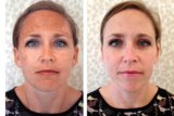 How I Did This: Fading Hormonal Hyperpigmentation Without Lasers